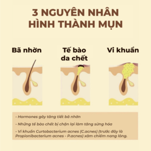 Nguyên nhân hình thành mụn